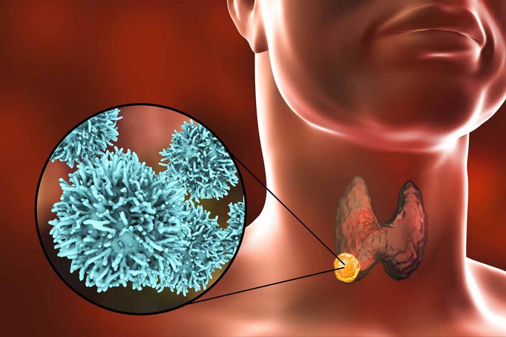 3D illustration of thyroid gland cancer