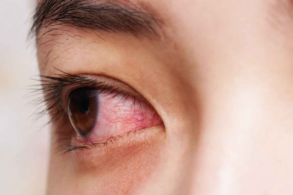 Close-up of a woman's red eye infection