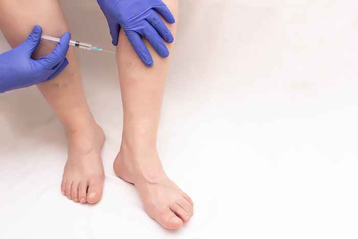 Doctor injecting the leg of a person with varicose veins