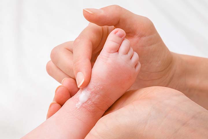 Woman applying lotion to the ankle of a child who has eczema