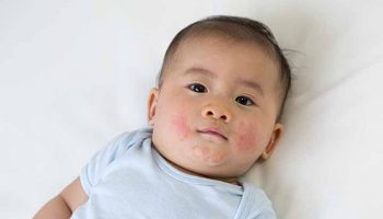 Baby with eczema on his face looking up while lying down.