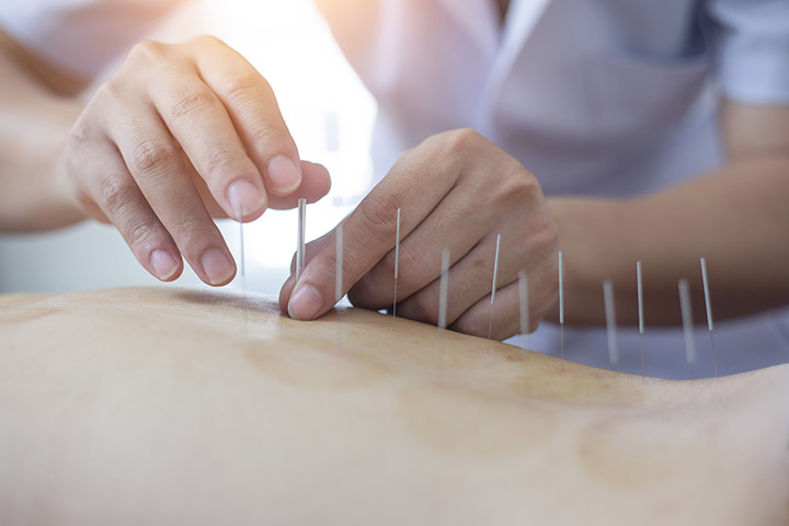 TCM physician carefully applies acupuncture needles to a patient with cupping therapy marks