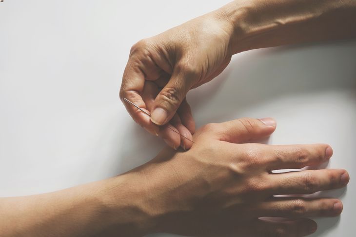 An overhead shot of a hand inserting an acupuncture needle into someone else’s hand