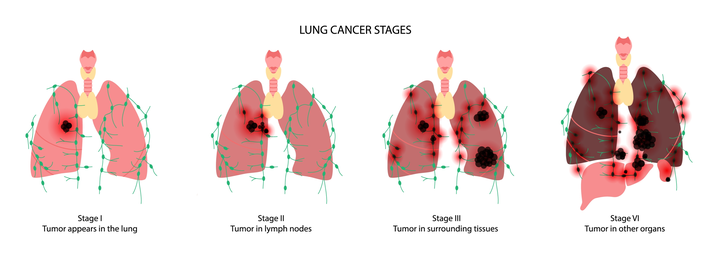 Illustration of the four stages of lung cancer