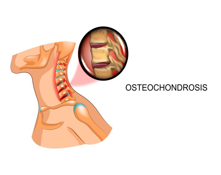 Illustration showing osteochondrosis, a degenerative disc disease that can cause stiff neck pain