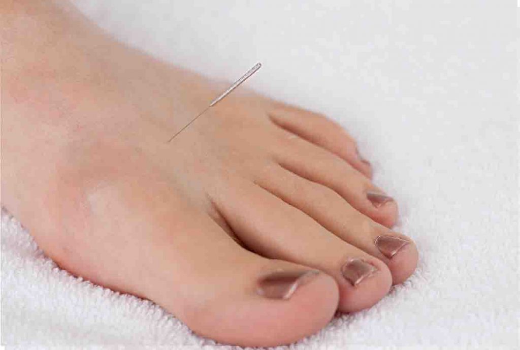 An acupuncture needle placed on the Tai Chong (LR3) acupressure point on someone’s foot