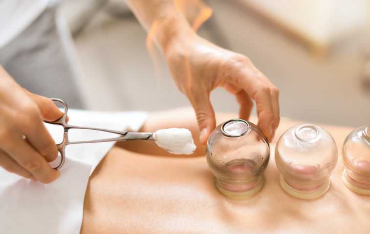 A woman therapist heating up a glass cupping tool on a patient's skin